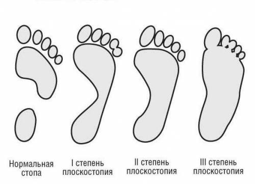 Имеется ли у меня пласкастопие, если да-то как его лечить за ранее.​