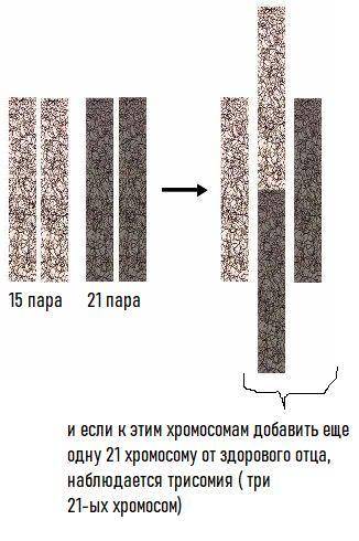13 Ребенок с клиническими проявлениями синдрома Дауна (трисомия по 21 паре хромосом) имеет 46 хромос