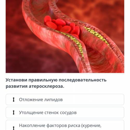 Правильна последовательность развития атеросклероза