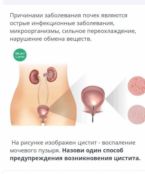 на рисунке изображен цистита воспаление мочевого пузыря Назови один предупреждение возникновения цис