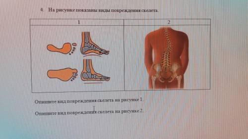 4. На рисунке показаны виды повреждения скелета. 1 2Опишите вид повреждения скелета на рисунке 1. Оп