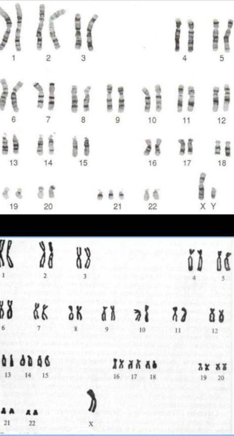 6. Изучите представленный кариотип: Используя карту кариотипа, определите и опишите заболевания чело