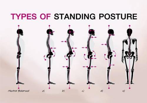 Определение осанки (нормальная,кифотическая,плоская,лордотическая,сутулая)