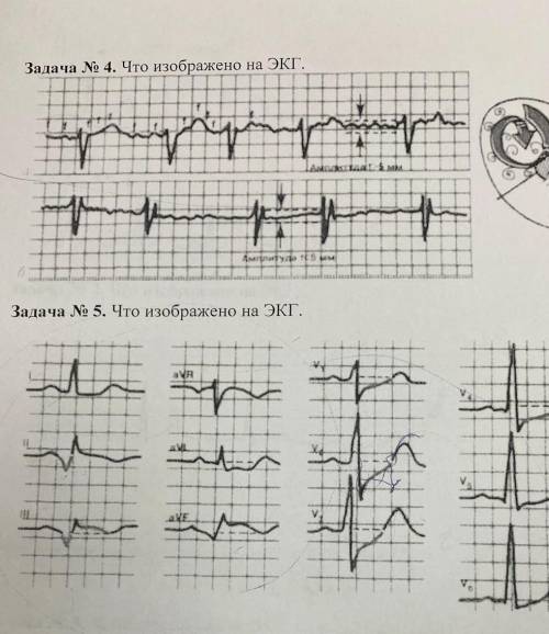 Задача N 4. Что изображено на ЭКГи немного рассказать